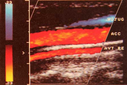bild duplexsonographie