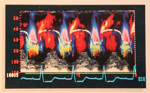 bild herzultraschall