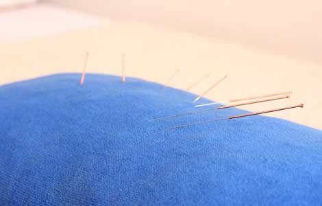 Bild Mesotherapie